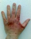 800px-Sodiumhydroxideburn[1].png